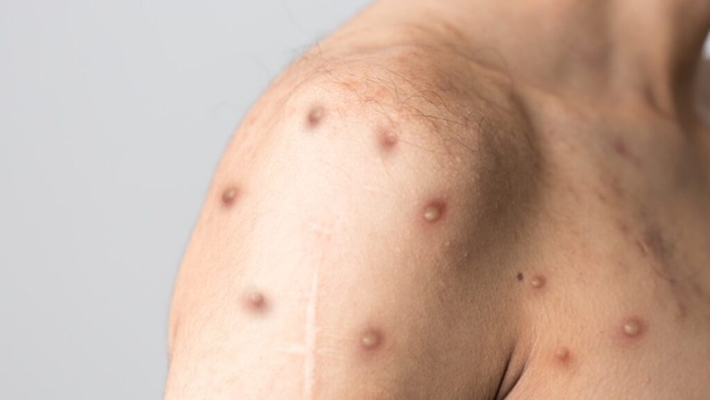 m cicegi virusu yayilmaya devam ediyor WGxyIMJP