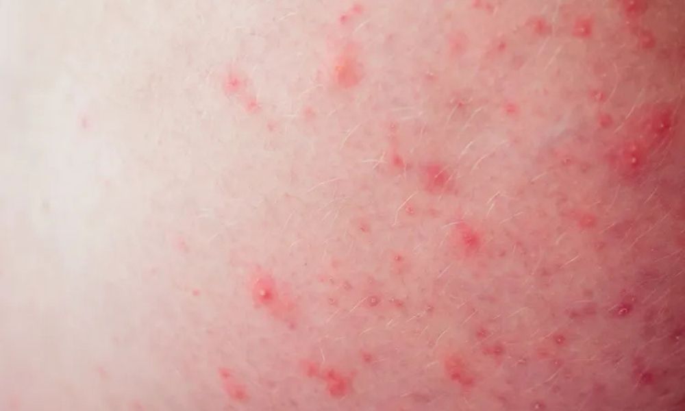 Popoda neden sivilce çıkar