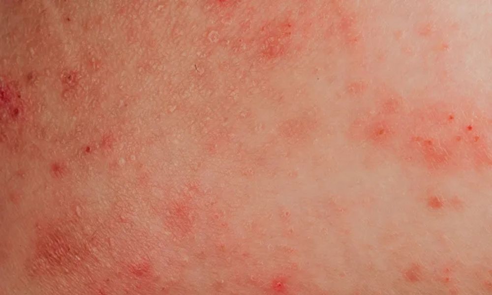 Popoda neden sivilce çıkar